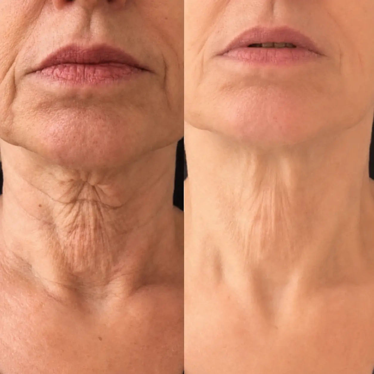 Vellura Peptide Micro Infusion Serum System – Professional Anti-Aging Treatment at Home