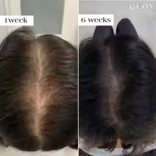 Velura Hair Growth Restoration System