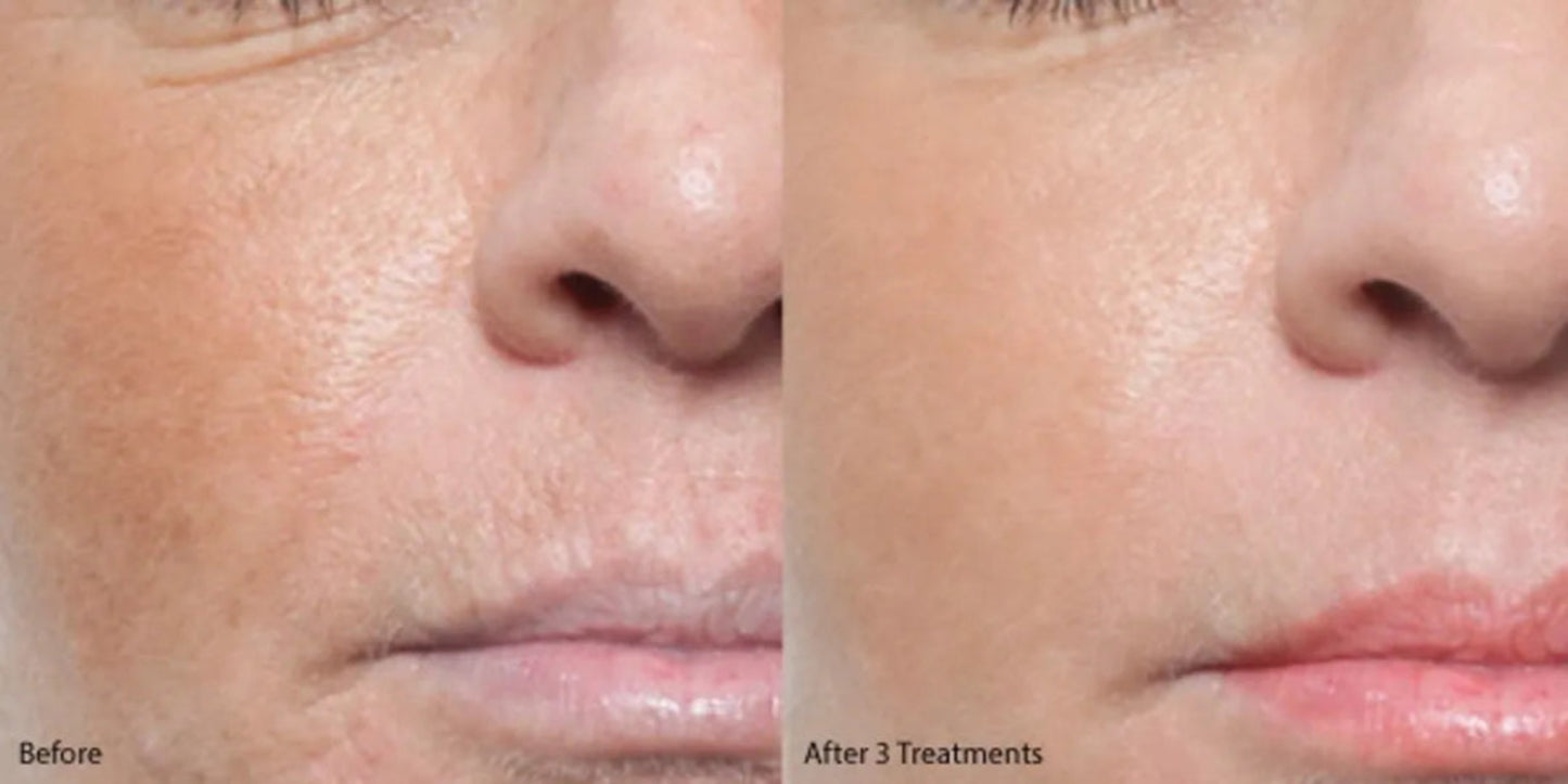 Skin concerns before treatment – wrinkles, dark spots, uneven texture