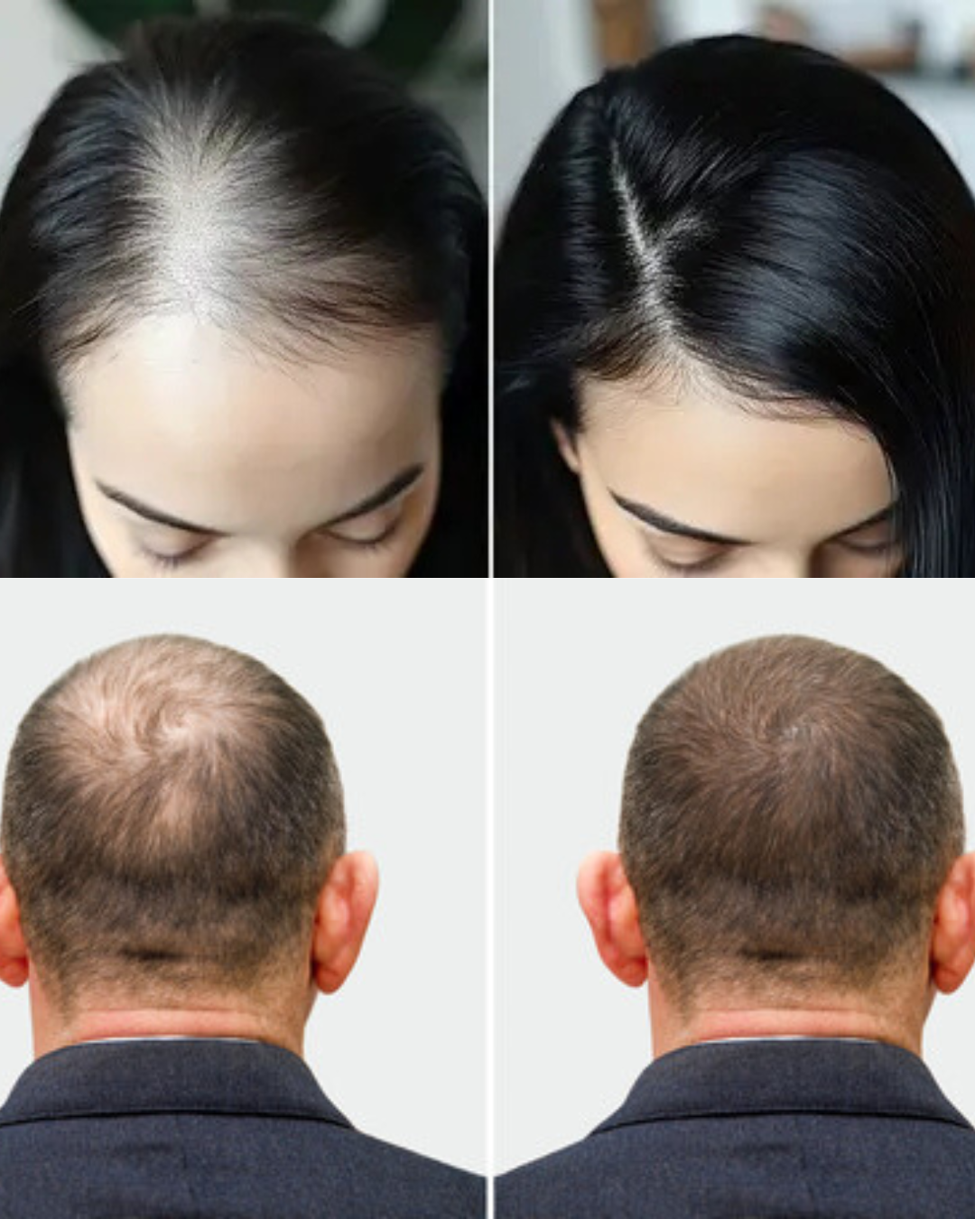 The Ultimate Natural Hair Mask for Hair Loss, Thinning Hair & Scalp Problems – Boosted with Vellura Micro-Infusion