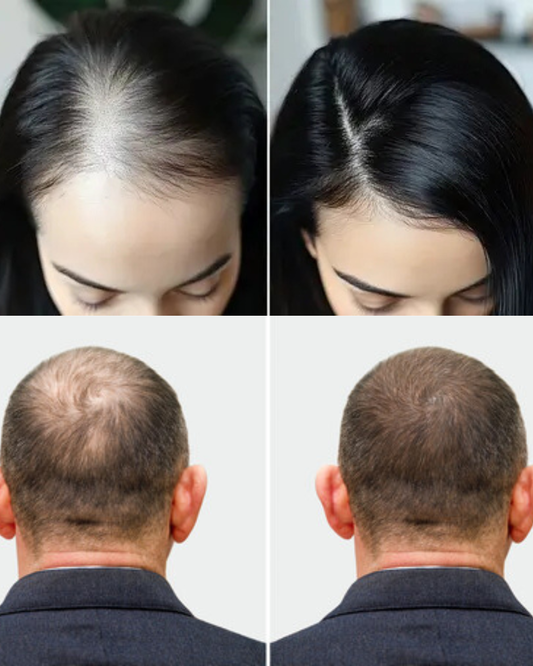The Ultimate Natural Hair Mask for Hair Loss, Thinning Hair & Scalp Problems – Boosted with Vellura Micro-Infusion