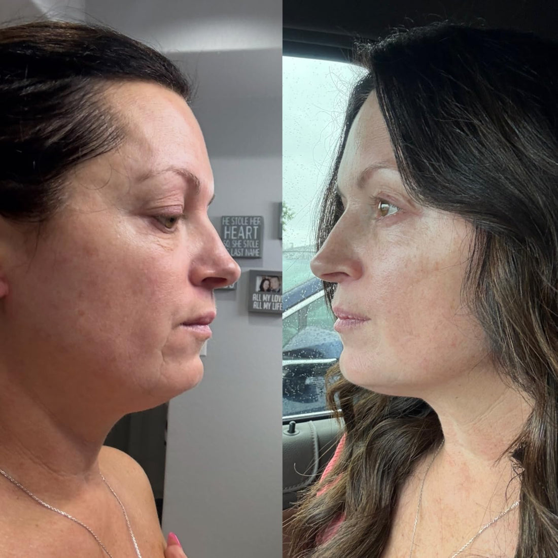 Discover the Secret to Radiant, Youthful Skin: Vellura Microinfusion System