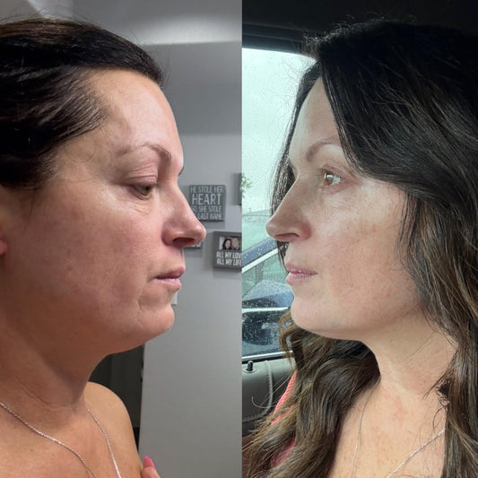 Discover the Secret to Radiant, Youthful Skin: Vellura Microinfusion System