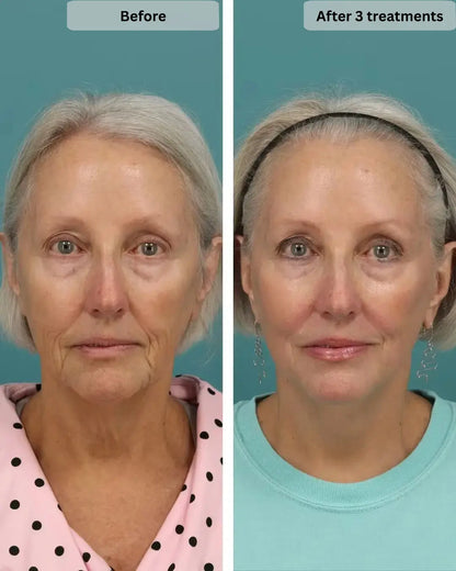 A side-by-side before and after comparison photo of a woman's face, labeled 'Before' on the left and 'After 3 treatments' on the right, against a teal background.
