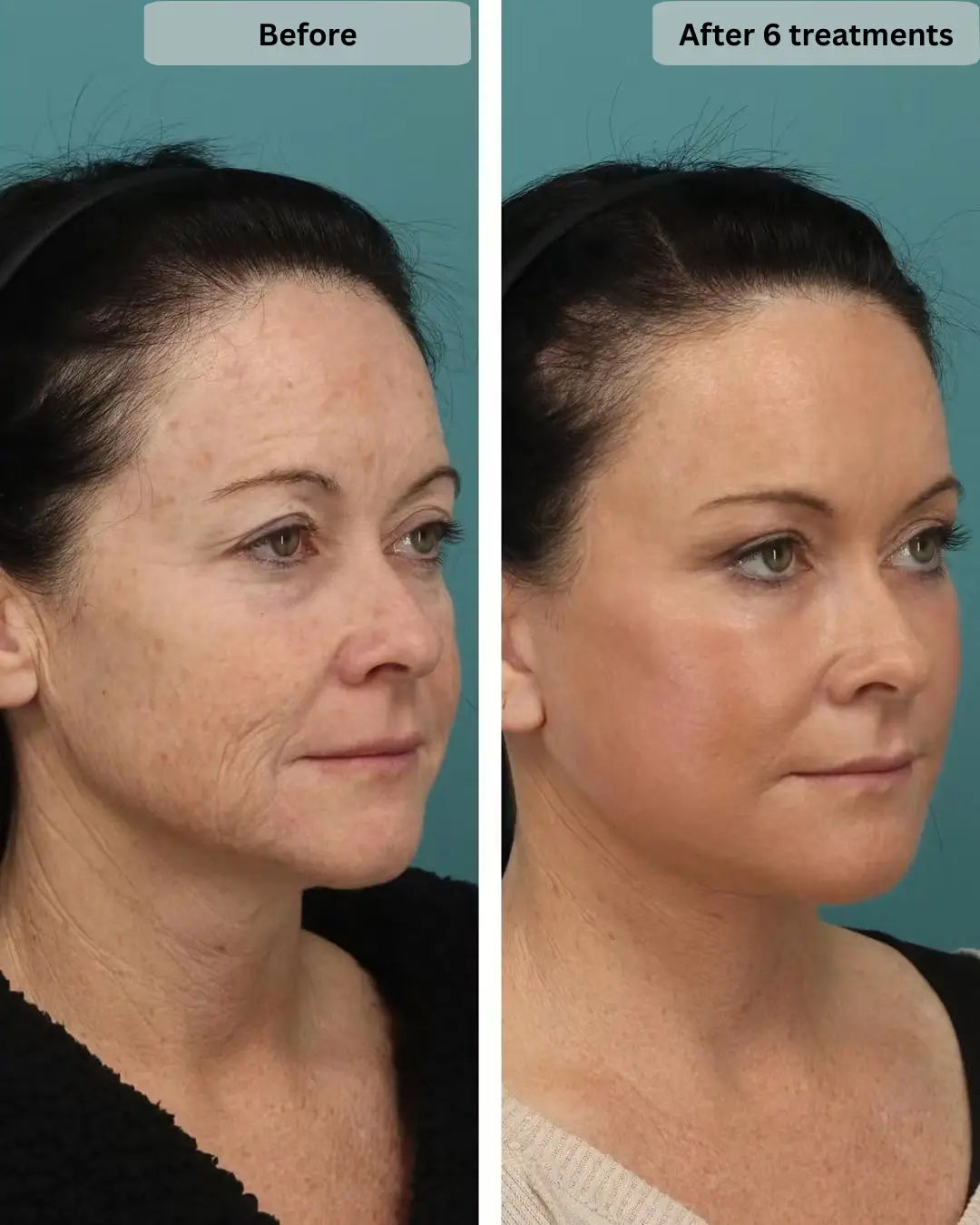 after 6 treatments micro infusion use vellura beauty