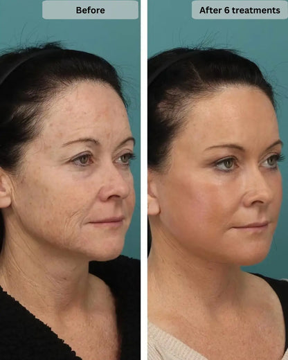 after 6 treatments micro infusion use vellura beauty