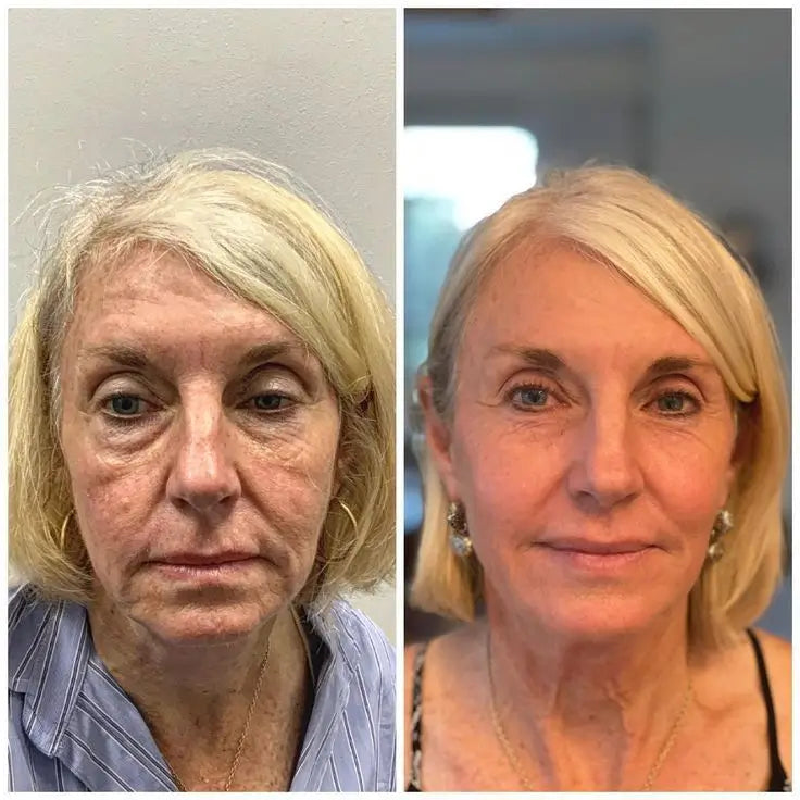 Vellura Peptide Micro Infusion Serum System – Professional Anti-Aging Treatment at Home