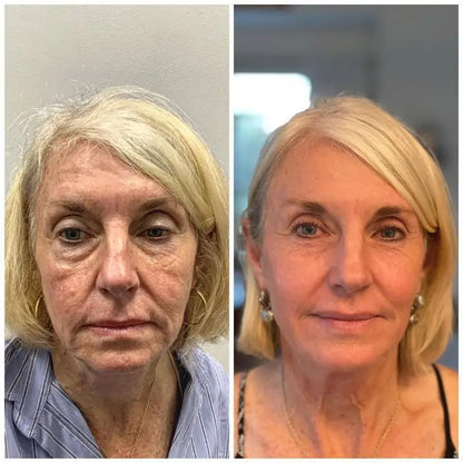 Vellura Peptide Micro Infusion Serum System – Professional Anti-Aging Treatment at Home