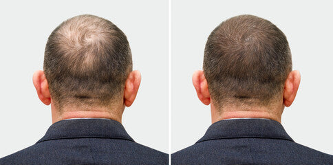 Before and after comparison of a person's hairline on a plain background