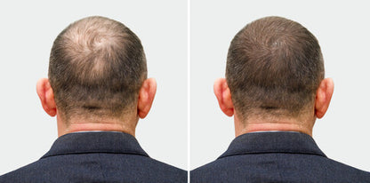 Before and after comparison of a person's hairline on a plain background
