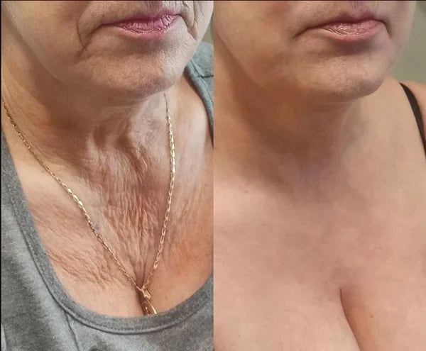 Side-by-side comparison of a woman's neck with and without visible lines or wrinkles.