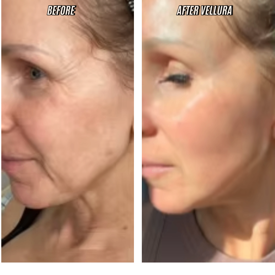 Before and after comparison of a woman's face with Vellura product application.