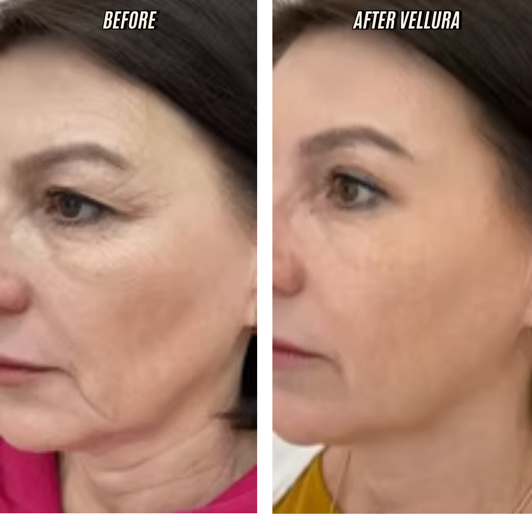 Before and after comparison of a woman's face with Vellura treatment.
