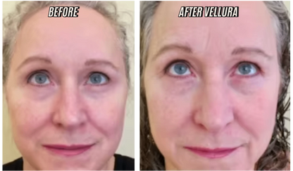 Before and after comparison of a person's face with Vellura treatment.
