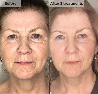 Before and after comparison of a woman's face with text indicating 'After 3 treatments'.