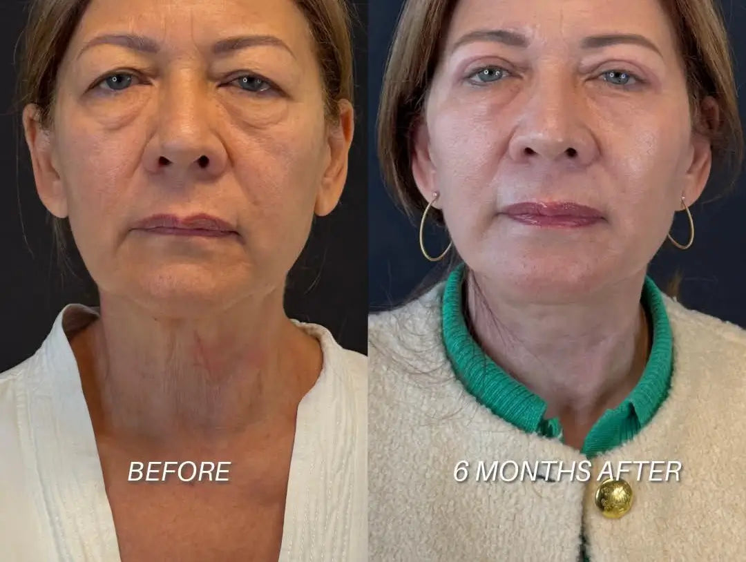 Before and after facial comparison of a woman, showing skin improvement over 6 months. The left side is labeled 'BEFORE' and the right side '6 MONTHS AFTER'.