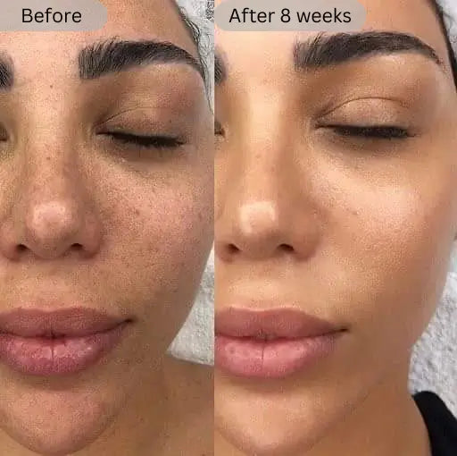 Before and after comparison of a woman's face with visible skin improvement over 8 weeks.