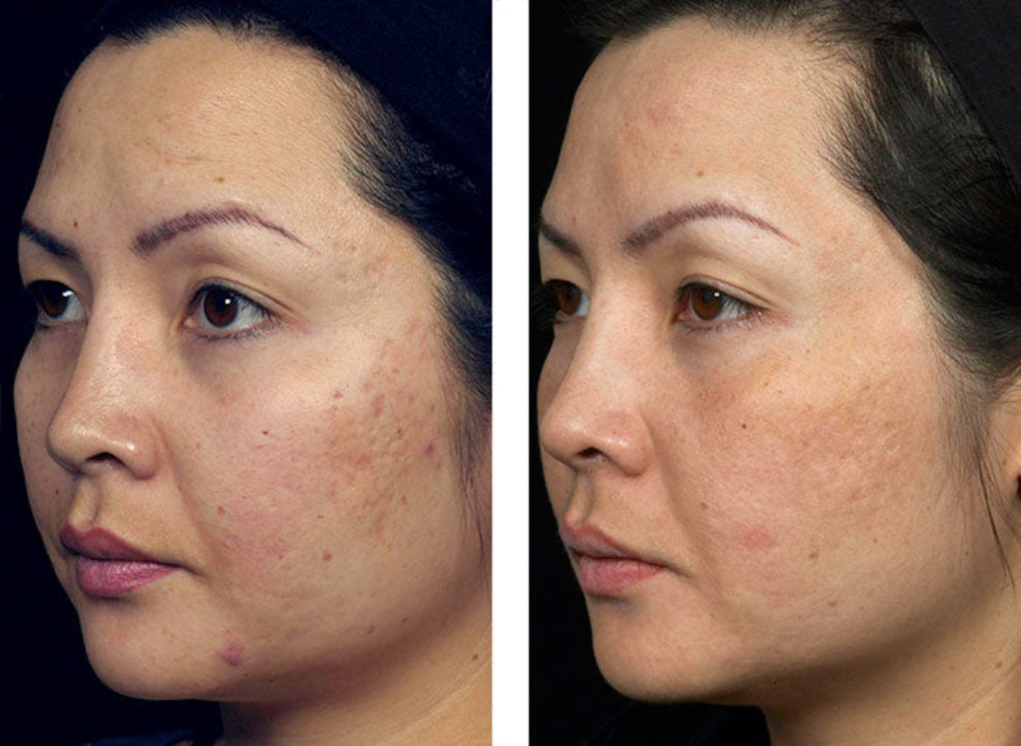Before and after comparison of a woman's face with visible skin texture changes.