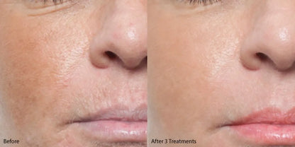 Skin concerns before treatment – wrinkles, dark spots, uneven texture



