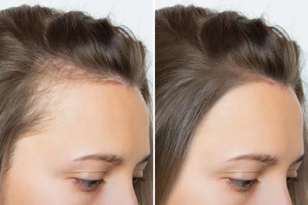 Side-by-side comparison of a person's hairline before and after treatment.