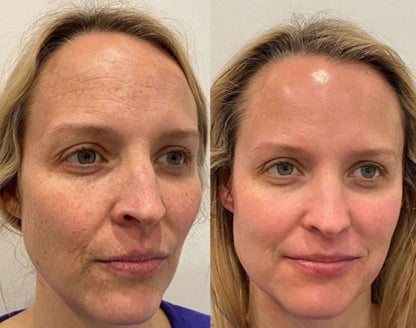 Before and after comparison of a woman's face with visible skin texture differences.