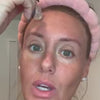 at-home microneedling before and after