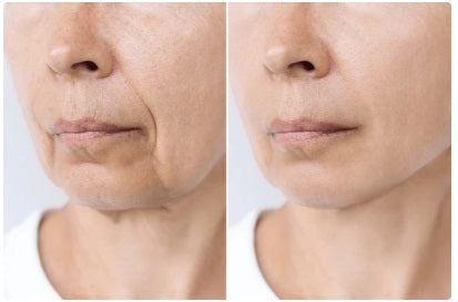Before and after comparison of a person's face with visible skin texture and lines.