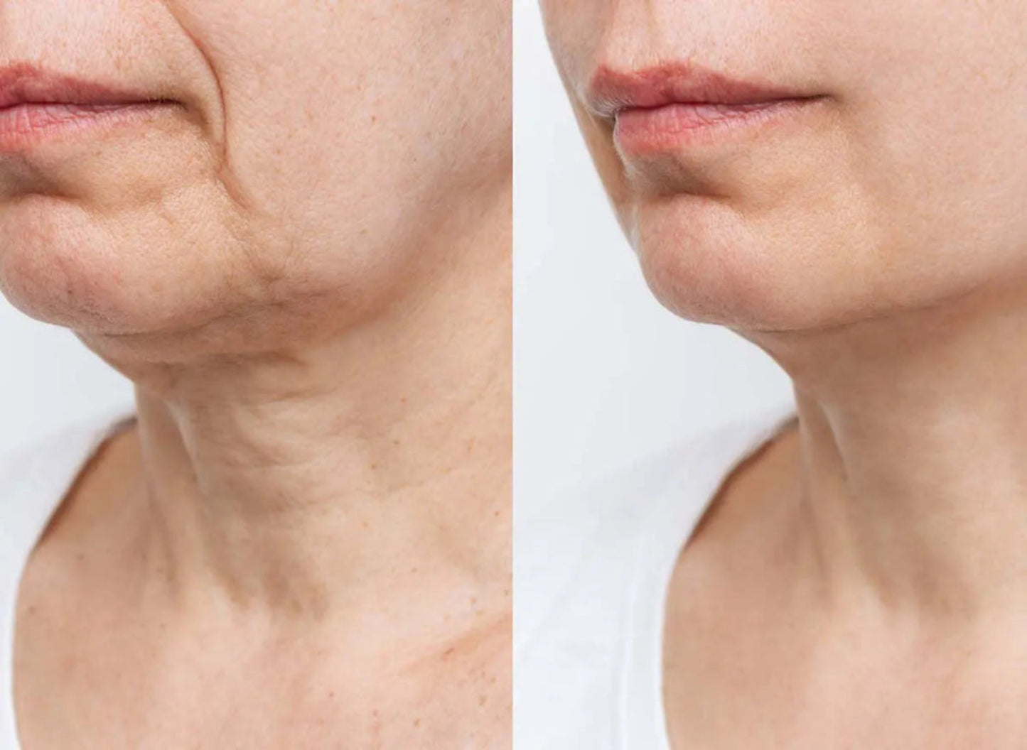 Before and after comparison of a woman's neck skin texture.