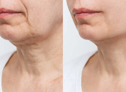 Before and after comparison of a woman's neck skin texture.