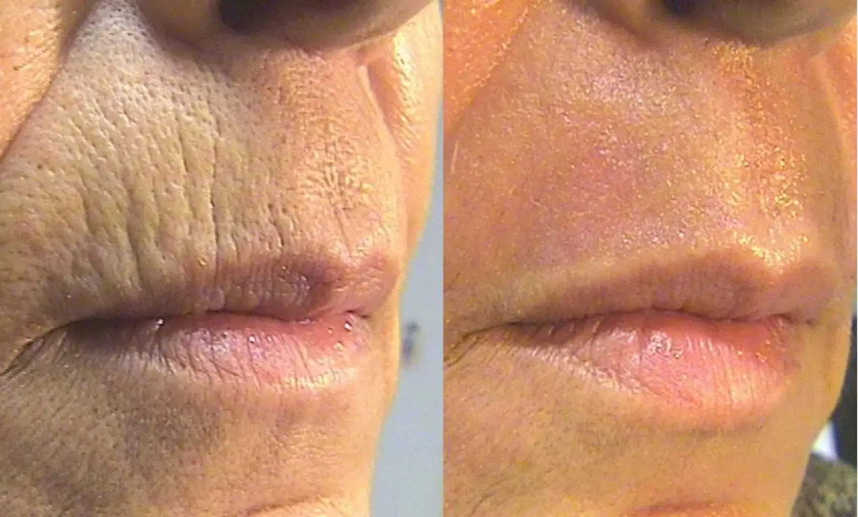 Before and after comparison of a person's lips.