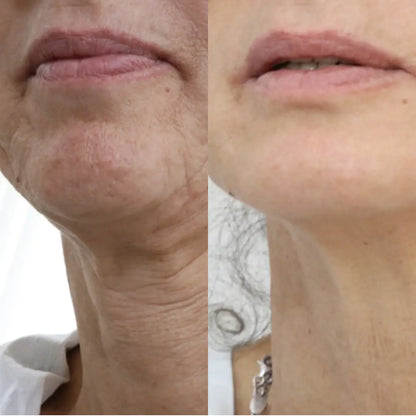 Before and after comparison of a person's neck and chin area with visible skin texture and lines.